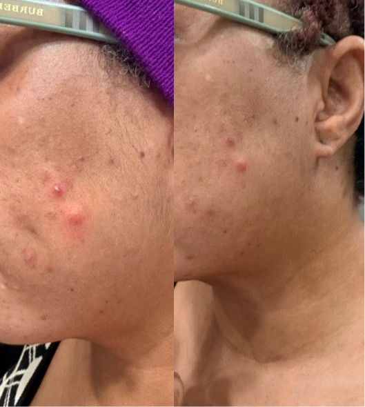 SALICYLIC POP (anti acne )serum set 1oz