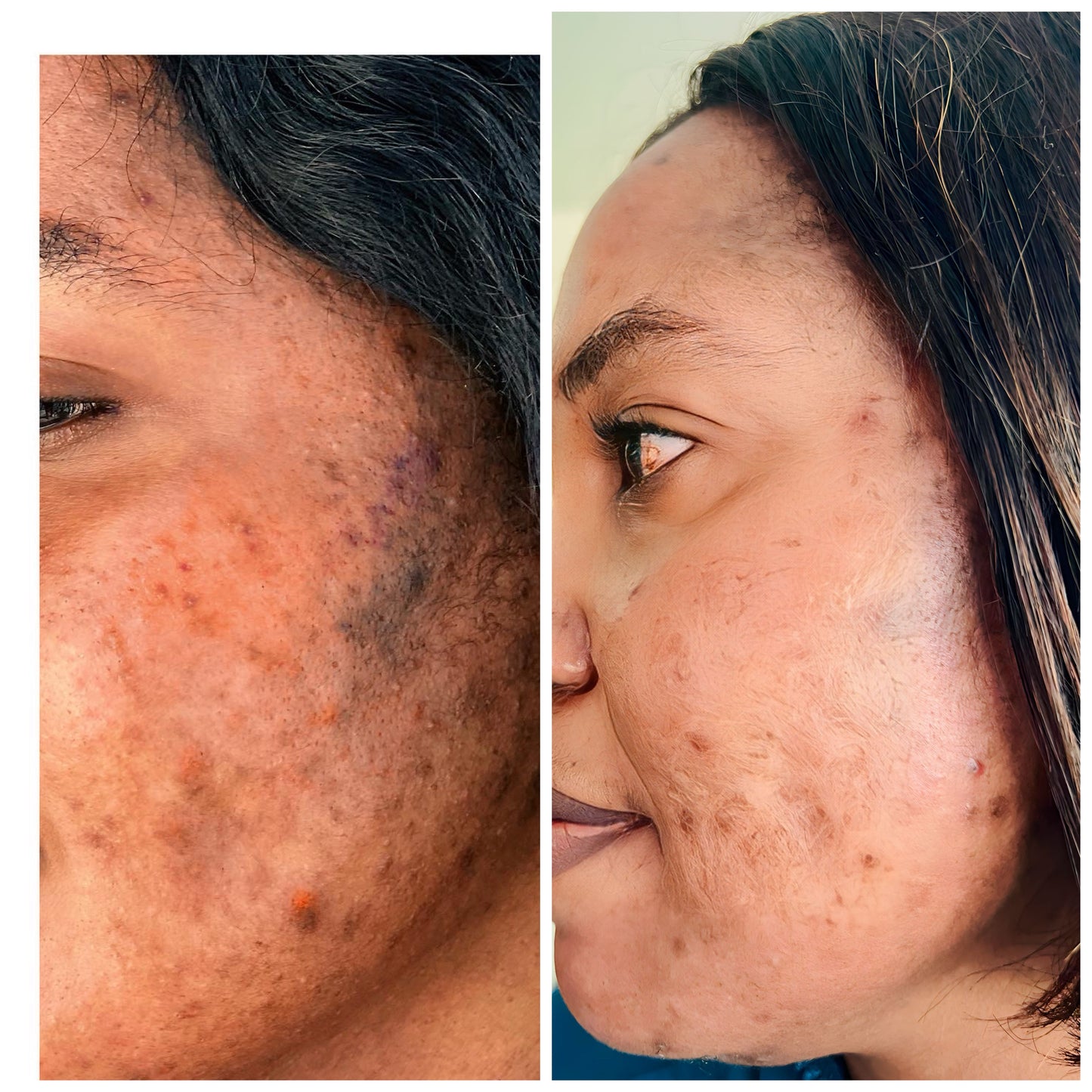 AcneGo ant acne cream