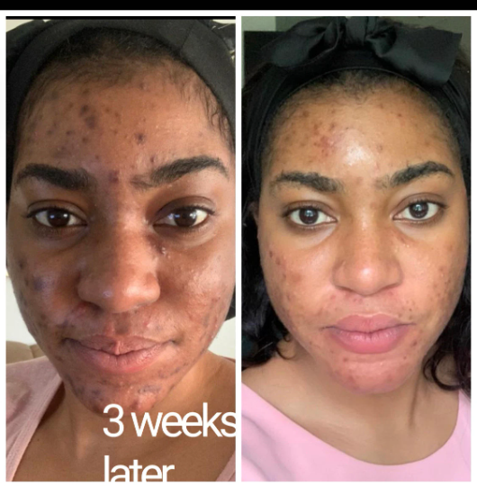 BLACK FRIDAY DEAL. EXTRA BEAUTIFYING BRIGHTENING ( complete combo ) BODY LOTION SET 6 plus free mug