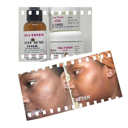 Anti Acne toner with dark spots remover